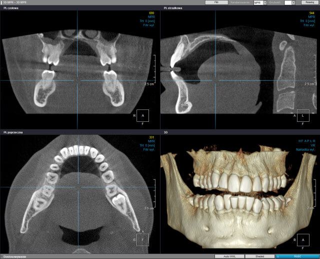 Tomografia CBCT zębów