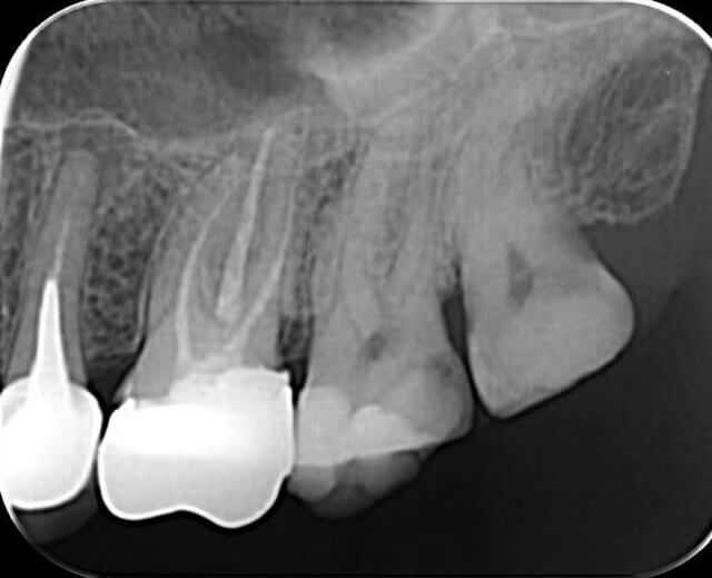 Zdjęcia wewnątrzustne
