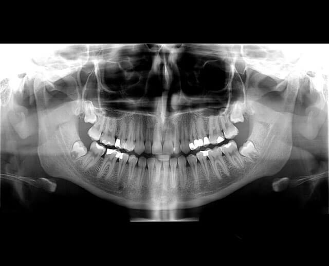 Pantomogramy cyfrowe